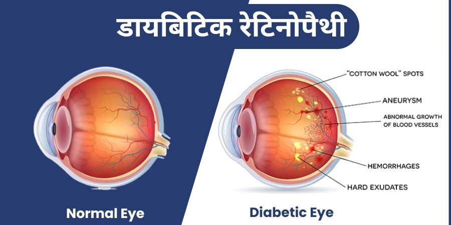 Diabetic-Retinopathy-900x450