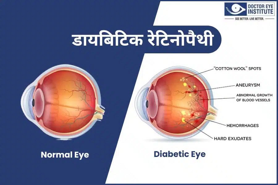 Diabetic-Retinopathy