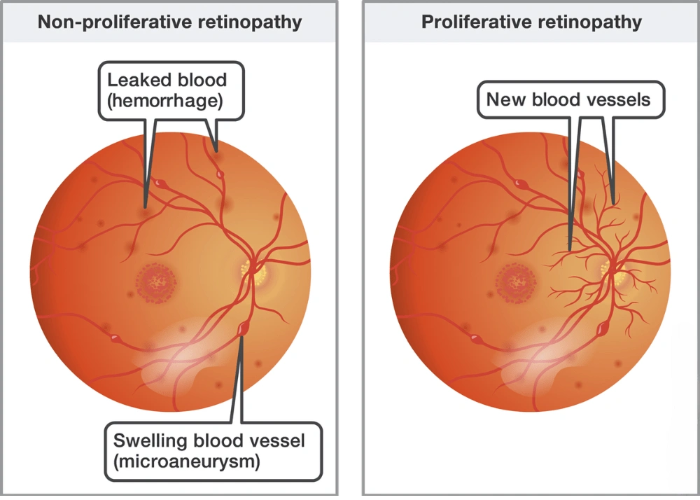 Types of diabetic retinopathy
