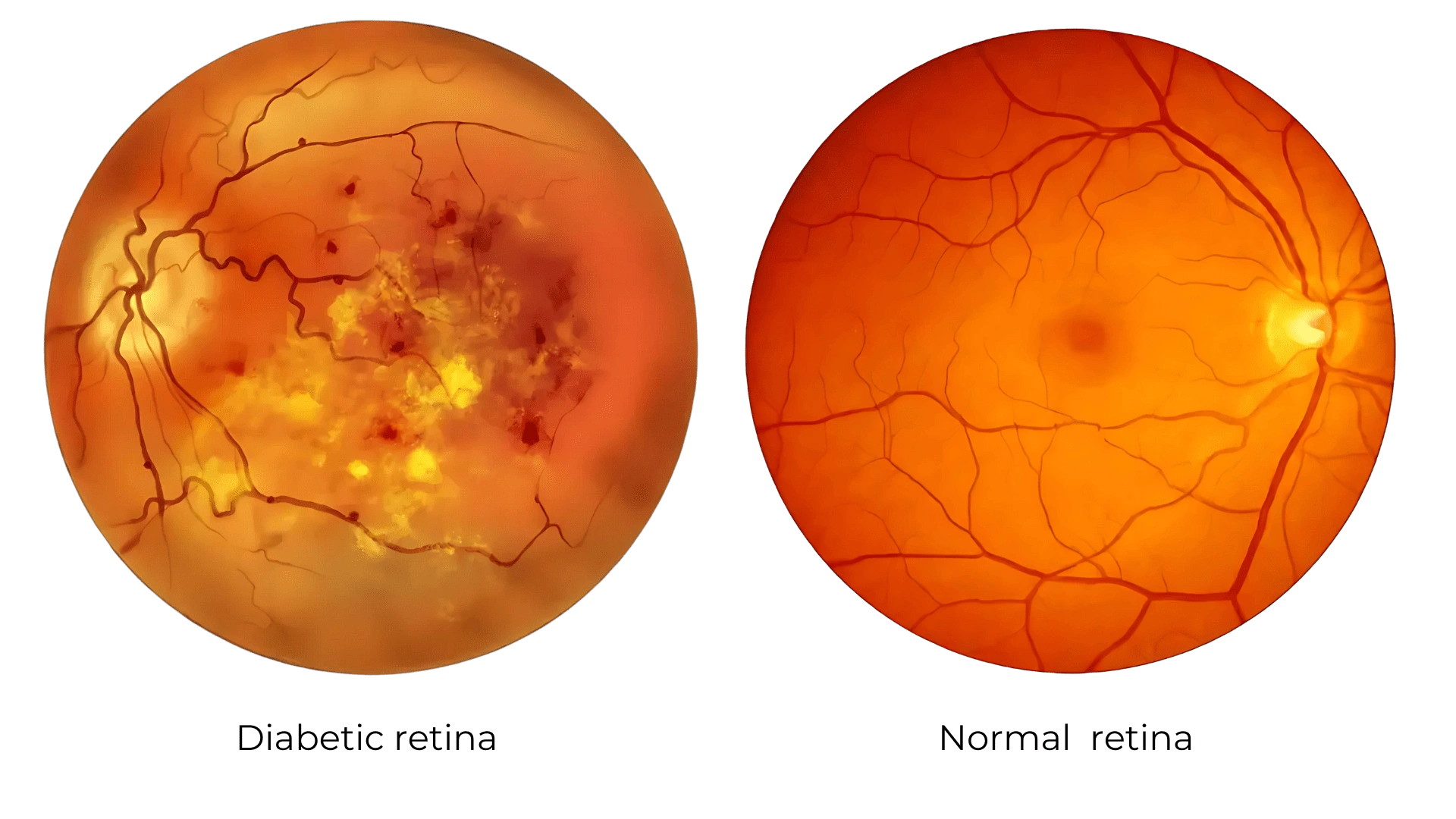 Diabetic Retinopathy Treatment in Andheri, Mumbai
