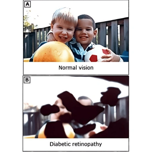 Diabetinopathy Retinopathy Patient