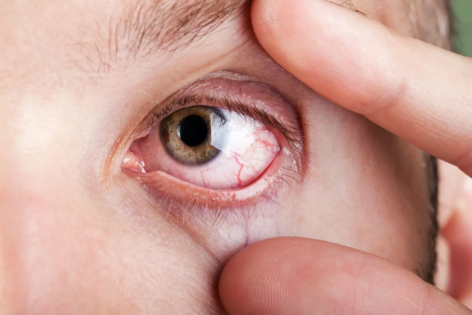Dry Eye Treatment in Andheri, Mumbai