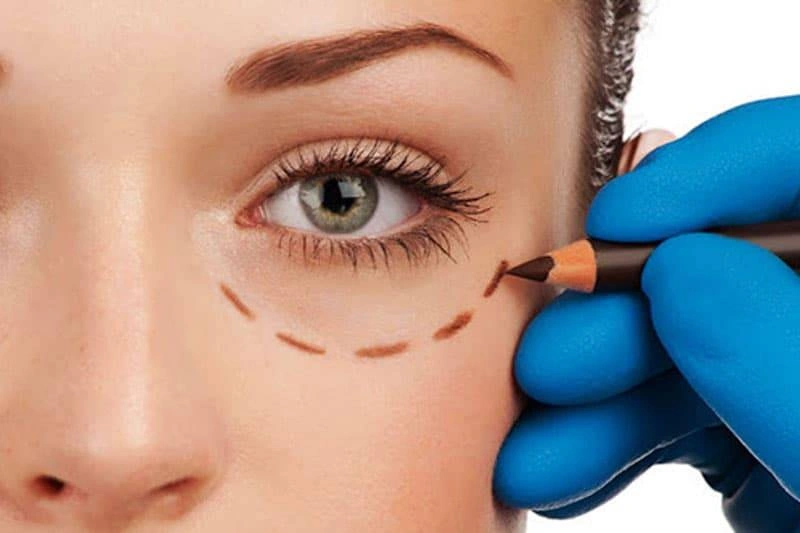 Oculoplasty Surgery in Andheri, Mumbai