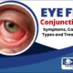 Eye Flu (Conjunctivitis)