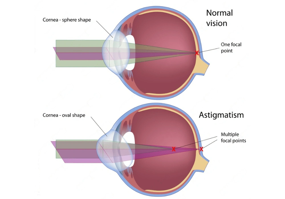 Astigmatism overview