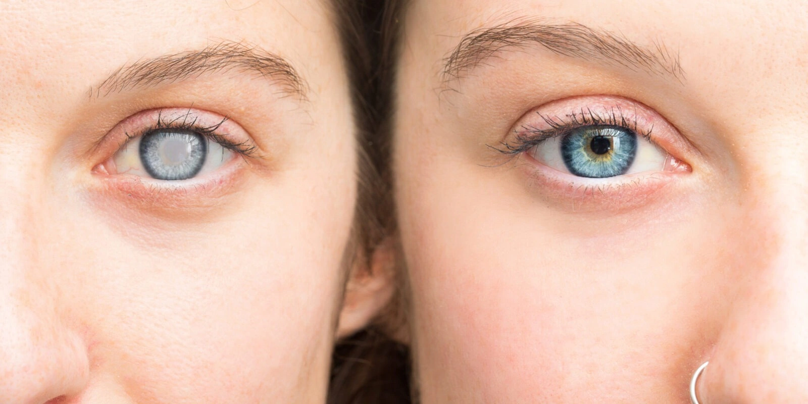 Diseases and Disorders of the Cornea