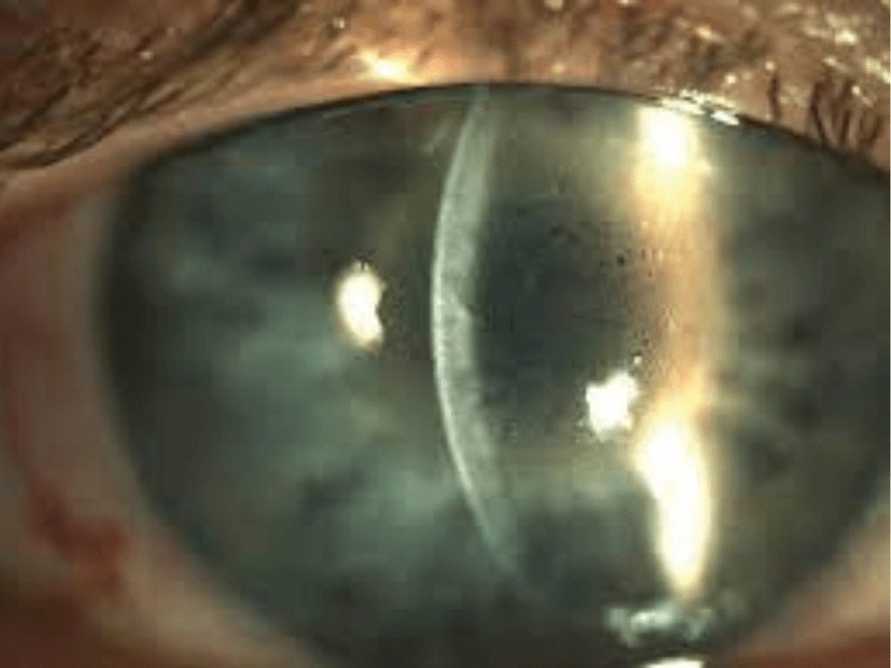 Corneal Dystrophies