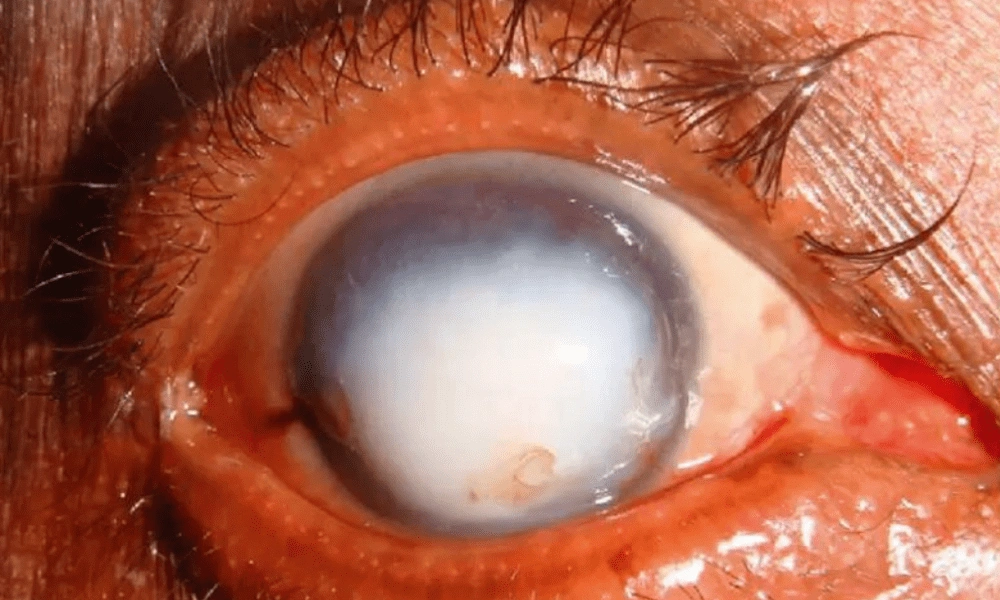 Corneal Ulcer