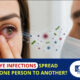Can Eye Infections Spread from One Person to Another?