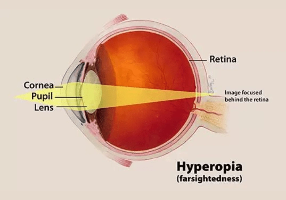 Hyperopia - 3D View