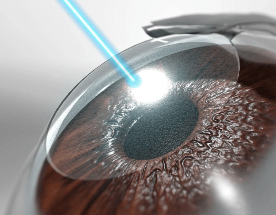 Femto Lasik Surgery in Andheri Mumbai