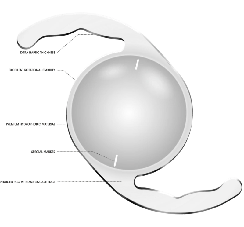 Toric IOLs (Monofocal and Multifocal Trifocal) for Astigmatism Correction and Clear Vision After Cataract Surgery