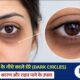 Dark Circles under the eyes