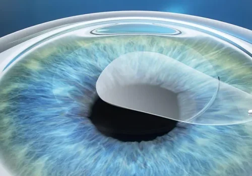 Modern CLEAR or Lenticule refractive surgery using advanced laser technology for clear vision