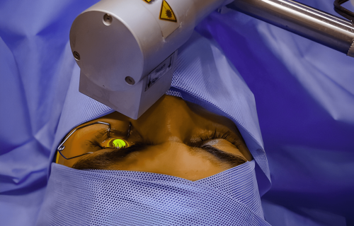 laser treatments keratoconus